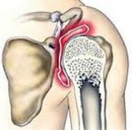 artroza liječenja zgloba ramena s hondroprotektorima