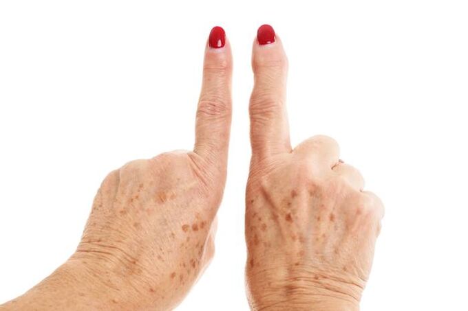 artroza falange liječenja prstiju
