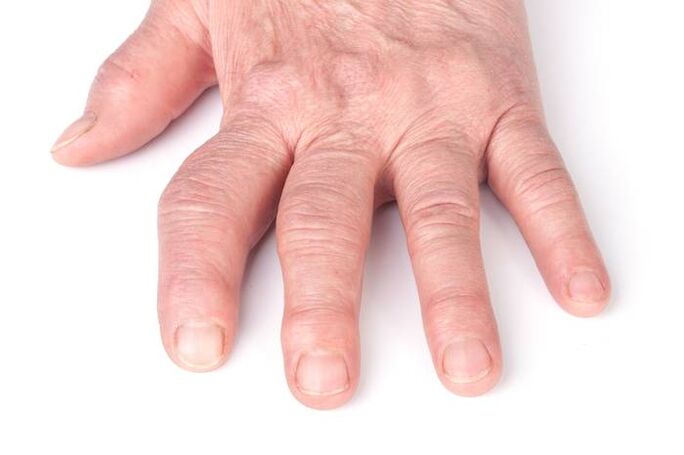 liječenje deformirajuće artroze prstiju bol u zglobu koljena pri okretanju