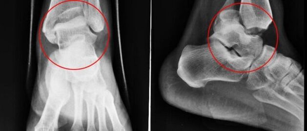 liječenje deformiteta zgloba artroze artroza terapije udarnim valovima zgloba koljena