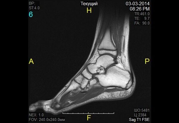 zašto postoji bol u koljenom zglobu jelevo jelo u liječenju artroze