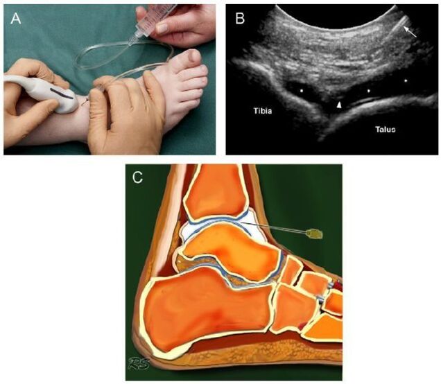 Artritis | Poliklinika Scipion