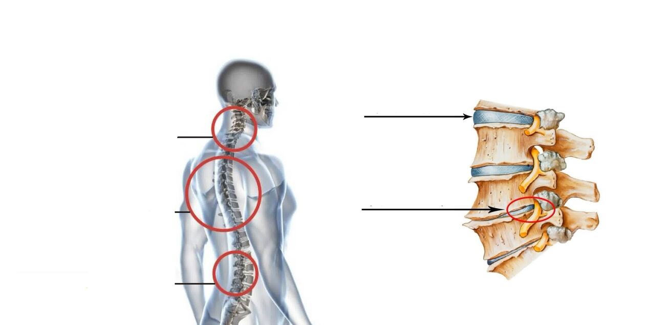 artroza pregleda lumbosakralne kralježnice uređaji za liječenje magnetoterapije artroze