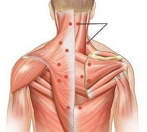 miozitis kao uzrok bolova u leđima