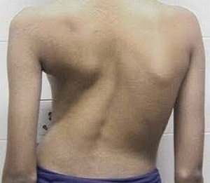 skolioza kao uzrok bolova u leđima