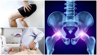 klasifikacija osteohondroze kralježnice