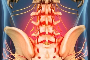 uzroci i simptomi osteohondroze