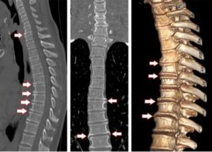 4. stupanj torakalne osteohondroze na CT snimanju