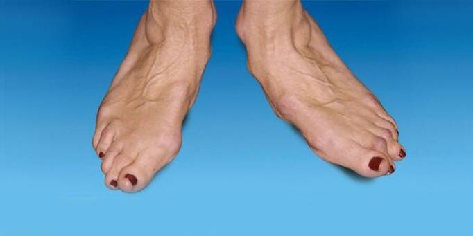 deformacija stopala s artrozom gležnja