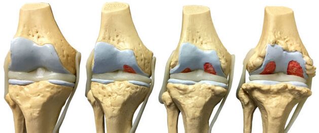 oštećenje zglobova u različitim fazama razvoja artroze gležnja