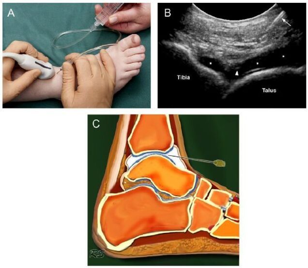 ultrazvuk skočnog zgloba s artrozom
