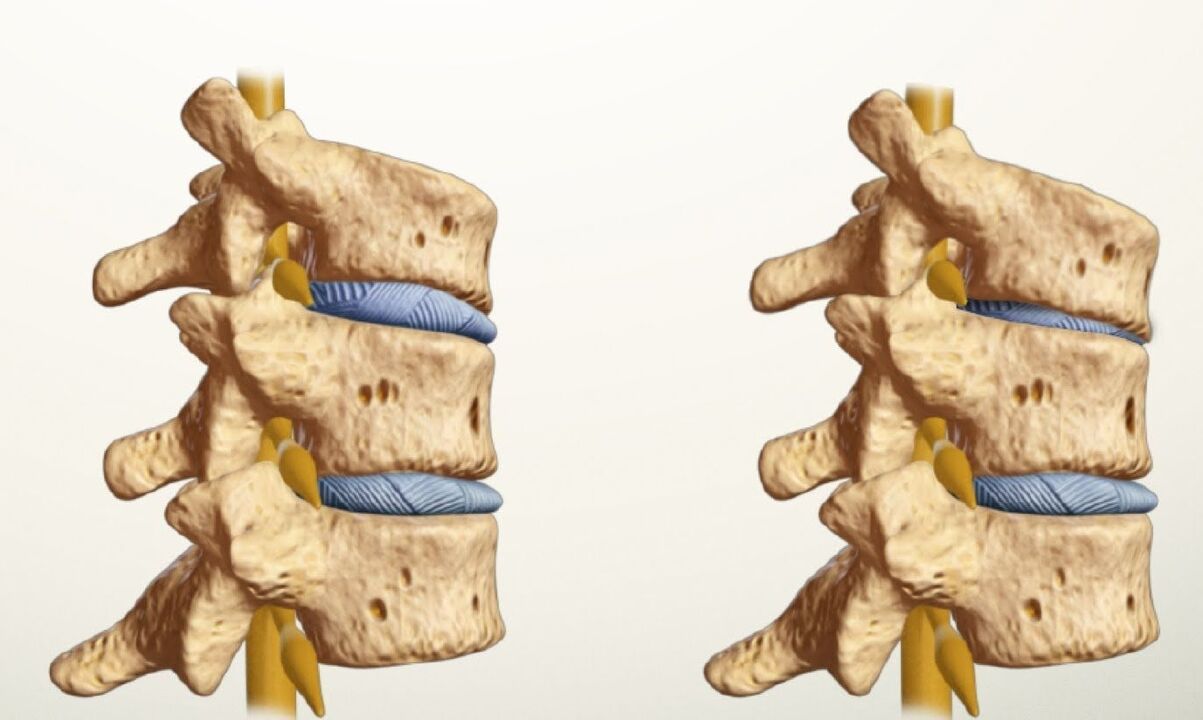 zdrava i bolesna kralježnica s lumbalnom osteohondrozo