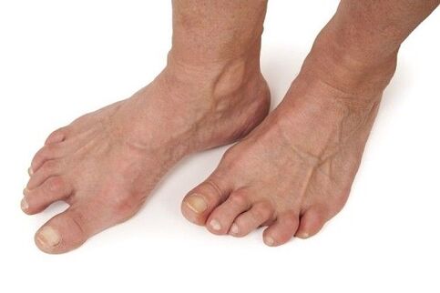 stopala zahvaćena artrozom