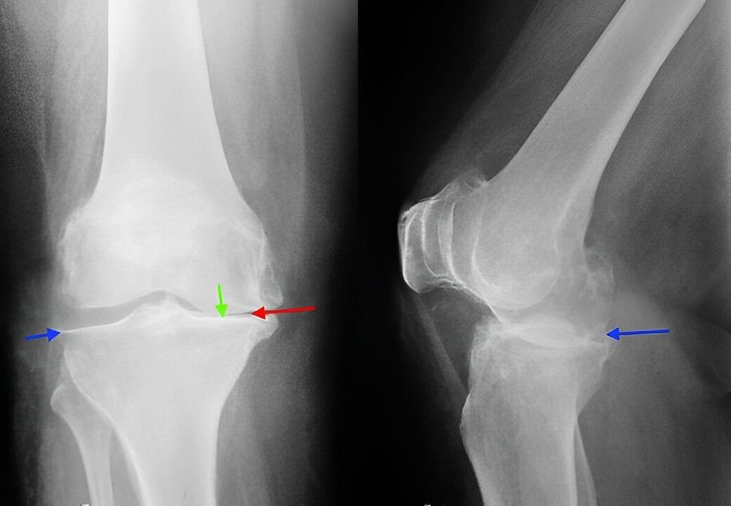 rendgenska slika artroze zgloba koljena