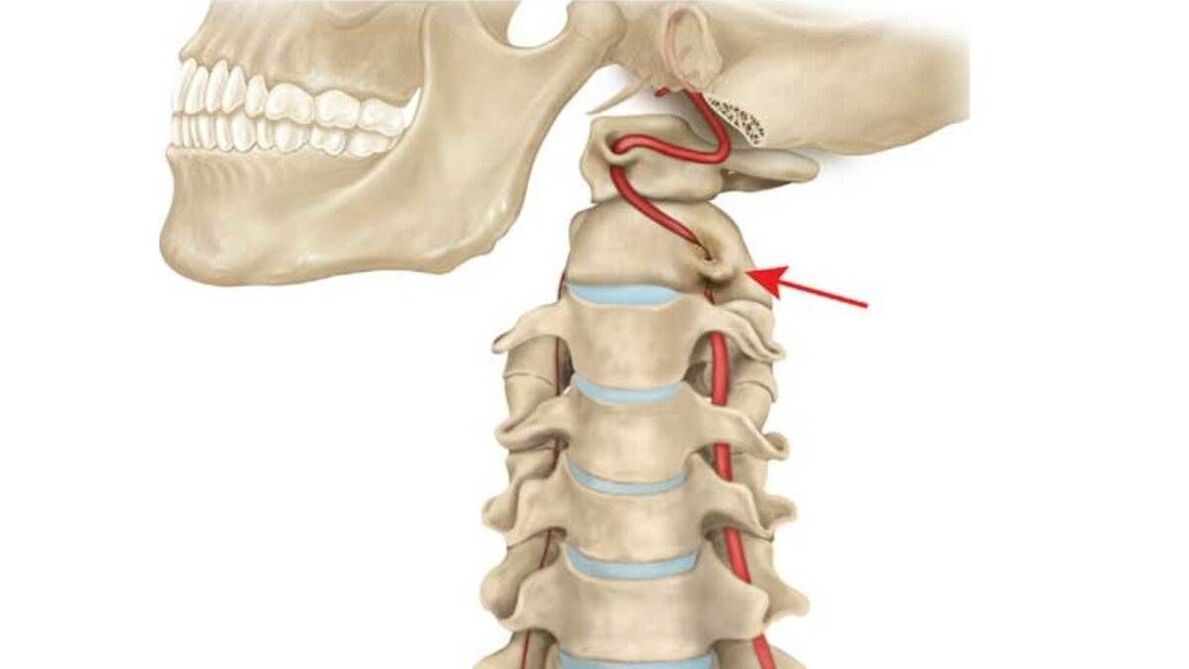 osteohondroza vratne kralježnice